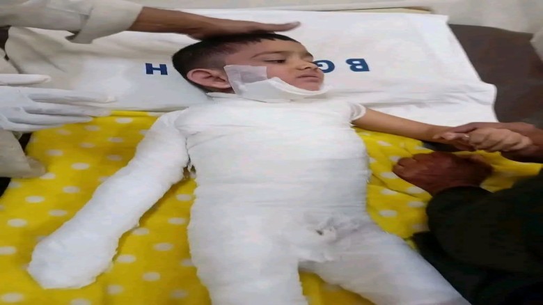 চন্দনাইশে গরম পানির পাতিলে পড়ে দগ্ধ শিশু মুস্তাকিম মারা গেল